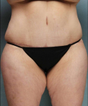 After Weight Loss Surgery Case 2 After
